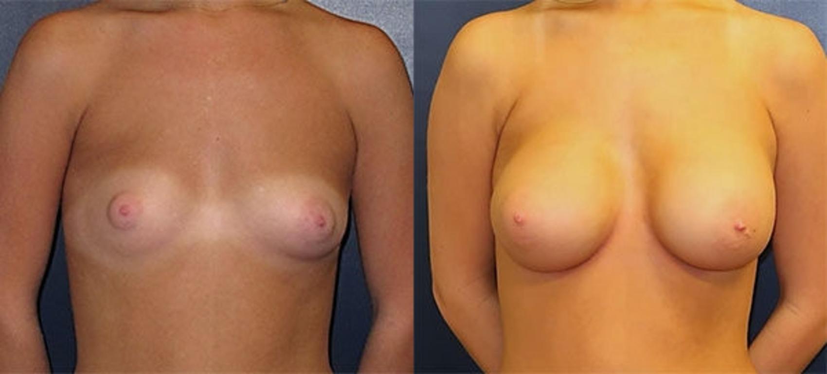 Before & After Breast Augmentation Case 13 Front View in Charleston, SC