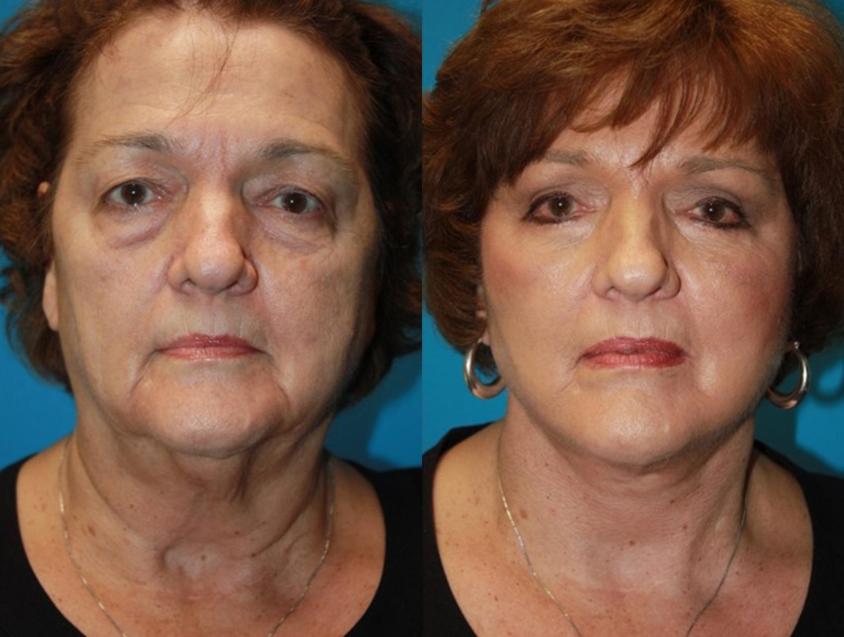 Before & After Facelift Case 72 Front View in Charleston, SC