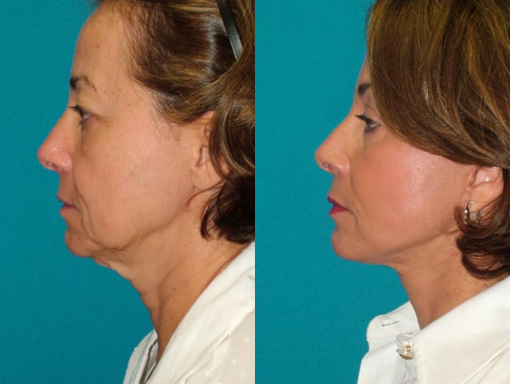 Before & After Facelift Case 74 Left Side View in Charleston, SC