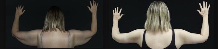 Before & After Arm Lift (Brachioplasty) Case 119 Back View in Charleston, SC