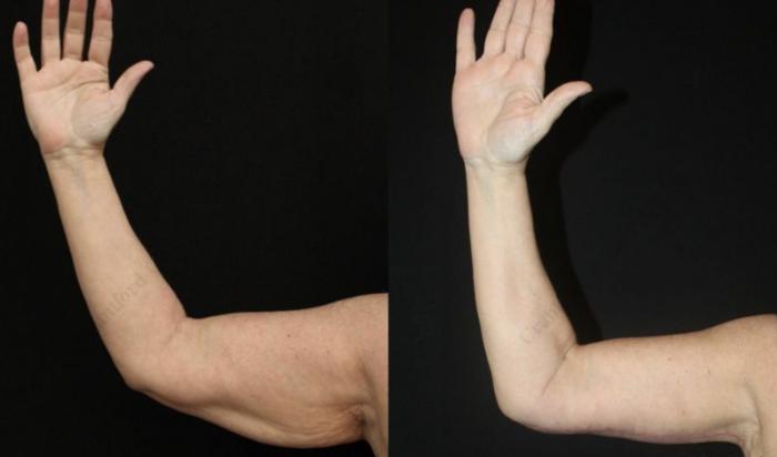 Before & After Arm Lift (Brachioplasty) Case 120 Front View in Charleston, SC