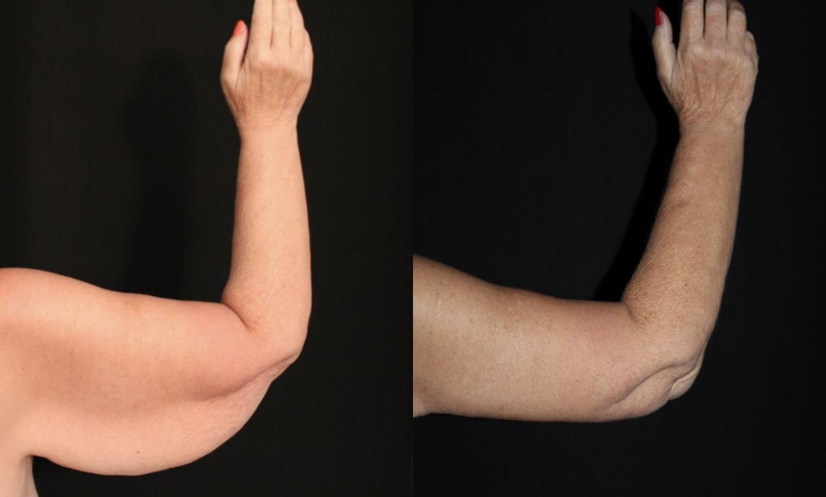 Before & After Arm Lift (Brachioplasty) Case 121 Back View in Charleston, SC