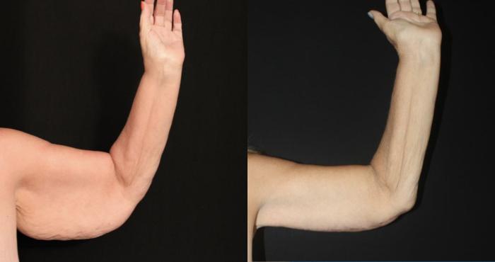 Before & After Arm Lift (Brachioplasty) Case 121 Front View in Charleston, SC