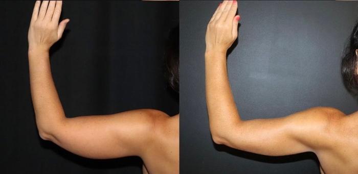 Before & After Arm Lift (Brachioplasty) Case 122 Back View in Charleston, SC