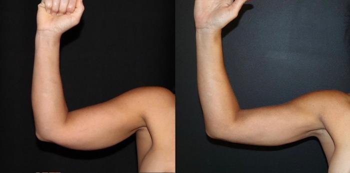Before & After Arm Lift (Brachioplasty) Case 122 Front View in Charleston, SC