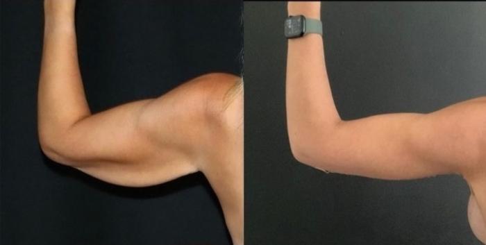 Before & After Arm Lift (Brachioplasty) Case 137 Back View in Charleston, SC
