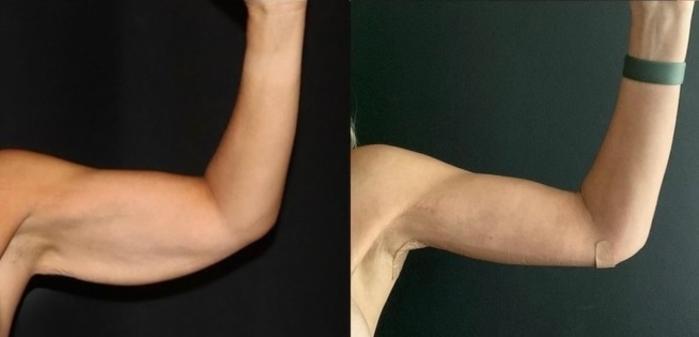 Before & After Arm Lift (Brachioplasty) Case 137 Right Side View in Charleston, SC
