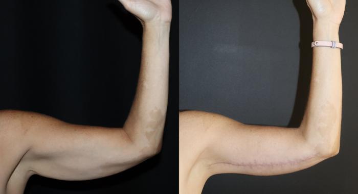 Before & After Arm Lift (Brachioplasty) Case 148 Front View in Charleston, SC
