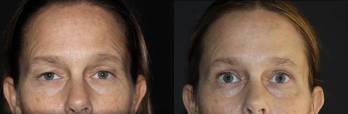 Before & After Blepharoplasty Case 162 Front View in Charleston, SC
