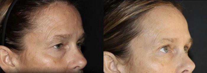 Before & After Blepharoplasty Case 162 Right Oblique View in Charleston, SC