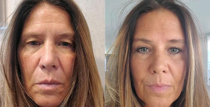 Before & After Blepharoplasty Case 34 Front View in Charleston, SC