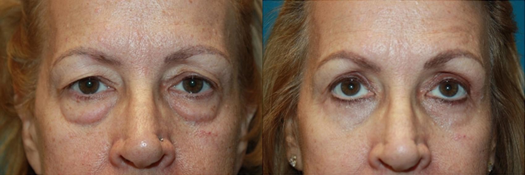 Before & After Blepharoplasty Case 43 Front View in Charleston, SC