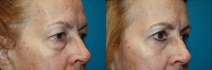 Before & After Blepharoplasty Case 43 Right Oblique View in Charleston, SC