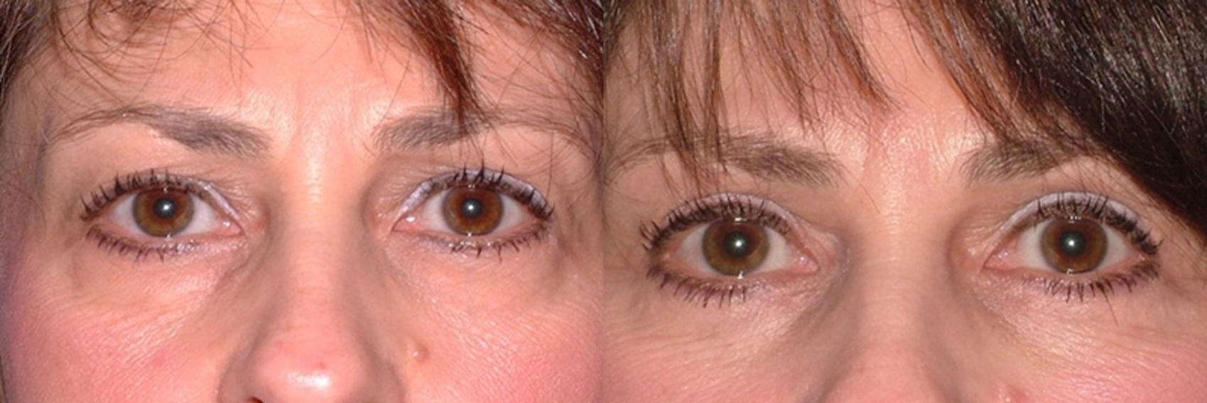 Before & After Blepharoplasty Case 44 Front View in Charleston, SC