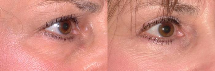 Before & After Blepharoplasty Case 44 Right Oblique View in Charleston, SC
