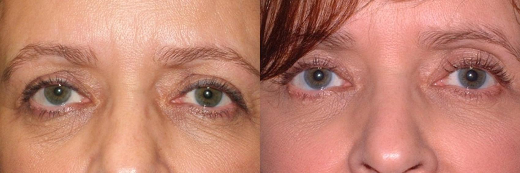 Before & After Blepharoplasty Case 45 Front View in Charleston, SC