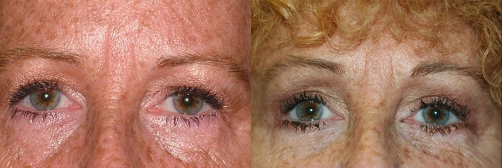 Before & After Blepharoplasty Case 46 Front View in Charleston, SC