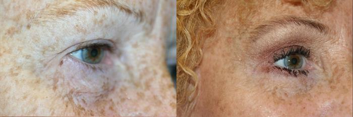 Before & After Blepharoplasty Case 46 Right Oblique View in Charleston, SC