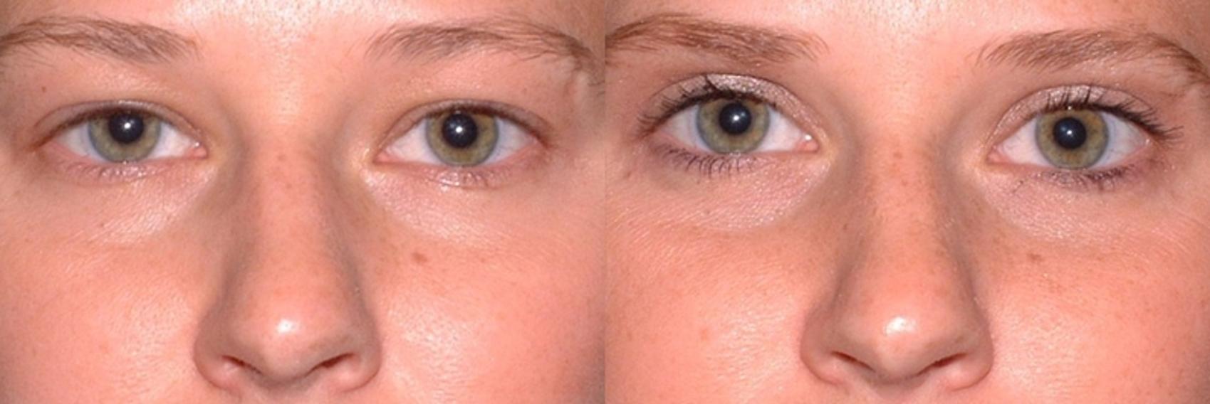 Before & After Blepharoplasty Case 47 Front View in Charleston, SC