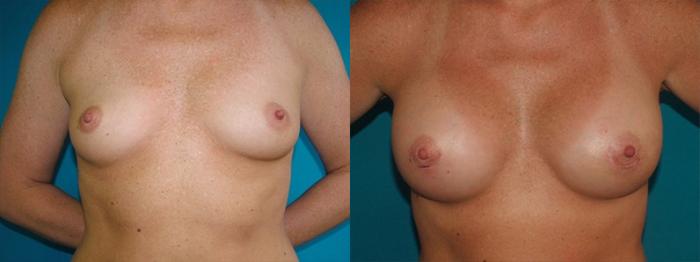 Before & After Breast Augmentation Case 1 Front View in Charleston, SC