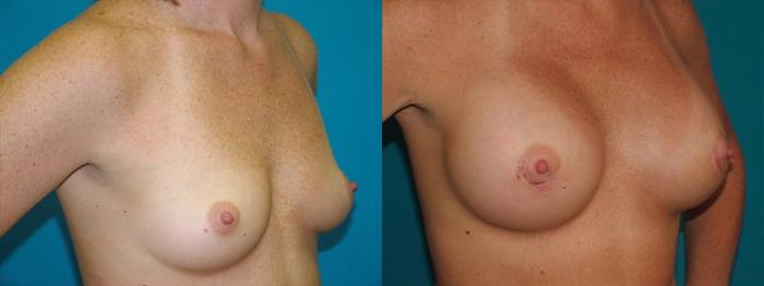 Before & After Breast Augmentation Case 1 Right Oblique View in Charleston, SC