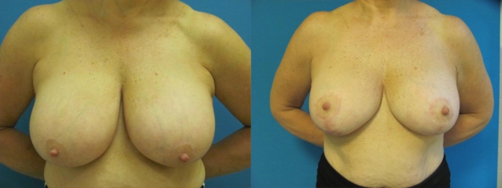 Before & After Breast Augmentation Case 10 Front View in Charleston, SC