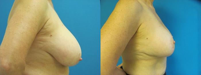 Before & After Breast Augmentation Case 10 Right Side View in Charleston, SC