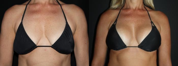 Before & After Breast Augmentation Case 101 Bikini View in Charleston, SC