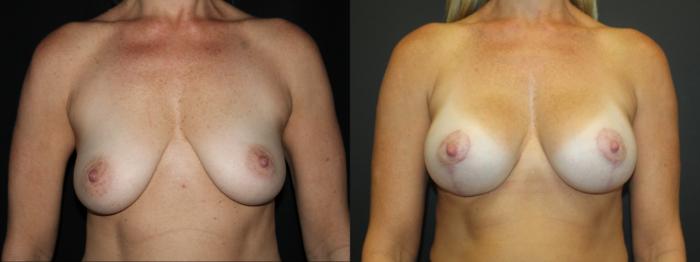 Before & After Breast Lift Case 101 Front View in Charleston, SC