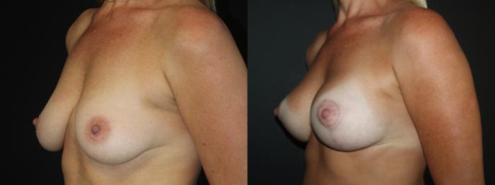 Before & After Breast Augmentation Case 101 Left Oblique View in Charleston, SC