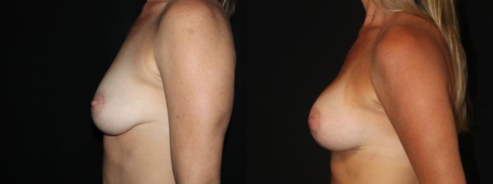 Before & After Breast Augmentation Case 101 Left Side View in Charleston, SC