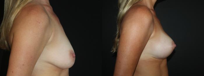 Before & After Breast Lift Case 101 Right Side View in Charleston, SC