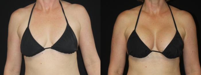 Before & After Breast Augmentation Case 102 Bikini View in Charleston, SC