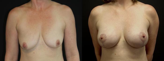 Before & After Breast Lift Case 102 Front View in Charleston, SC