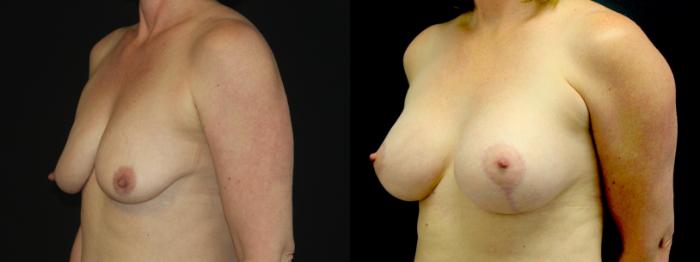 Before & After Breast Lift Case 102 Left Oblique View in Charleston, SC