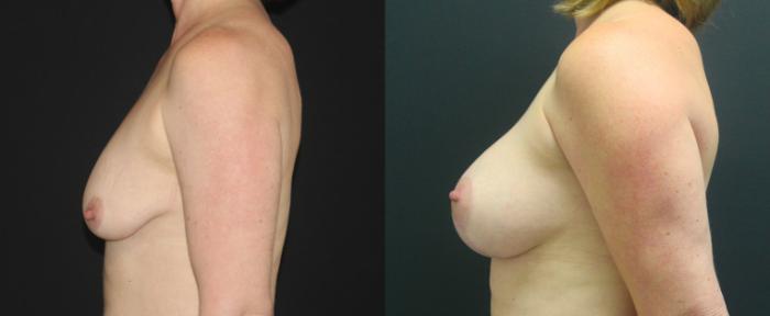 Before & After Breast Augmentation Case 102 Left Side View in Charleston, SC