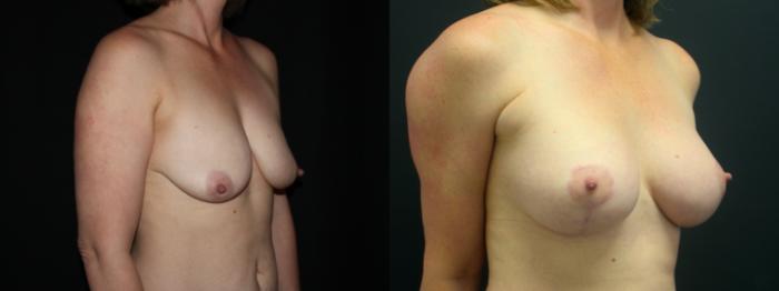 Before & After Breast Augmentation Case 102 Right Oblique View in Charleston, SC