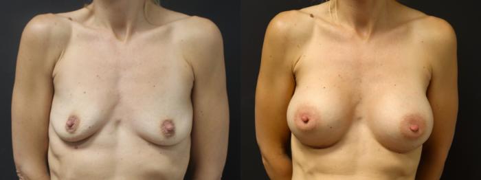 Before & After Breast Augmentation Case 103 Front View in Charleston, SC