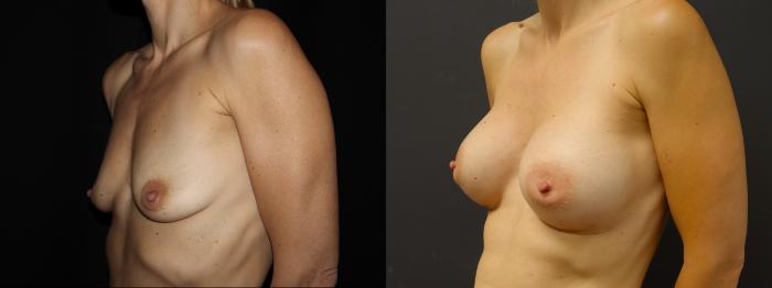 Before & After Breast Augmentation Case 103 Left Oblique View in Charleston, SC