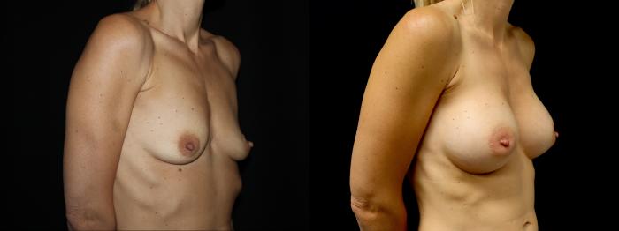 Before & After Breast Augmentation Case 103 Right Oblique View in Charleston, SC