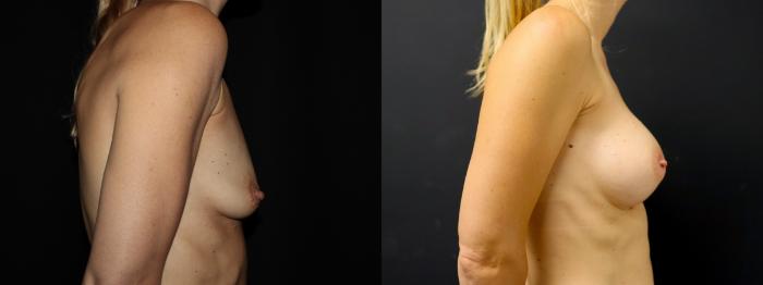 Before & After Breast Augmentation Case 103 Right Side View in Charleston, SC