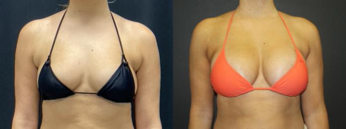 Before & After Breast Augmentation Case 104 Bikini View in Charleston, SC
