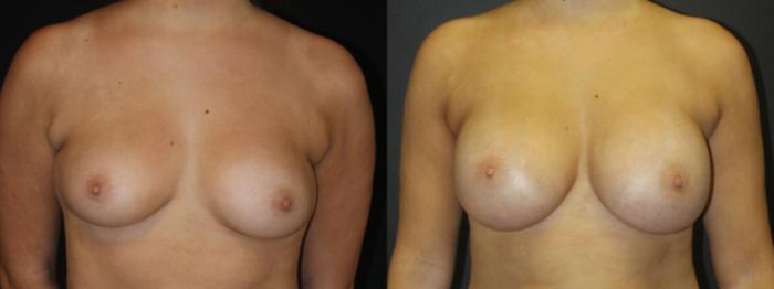 Before & After Breast Augmentation Case 104 Front View in Charleston, SC