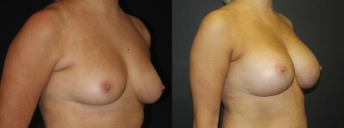 Before & After Breast Augmentation Case 104 Left Oblique View in Charleston, SC