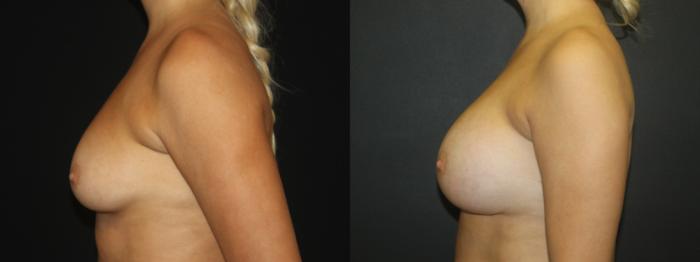 Before & After Breast Augmentation Case 104 Left Side View in Charleston, SC