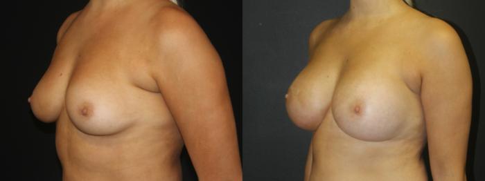 Before & After Breast Augmentation Case 104 Right Oblique View in Charleston, SC