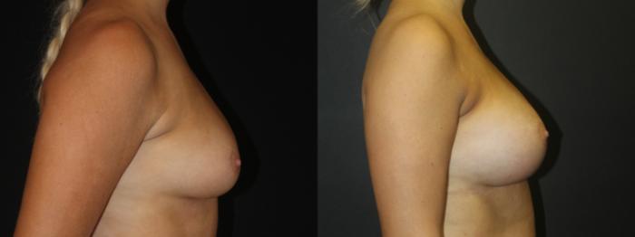Before & After Breast Augmentation Case 104 Right Side View in Charleston, SC