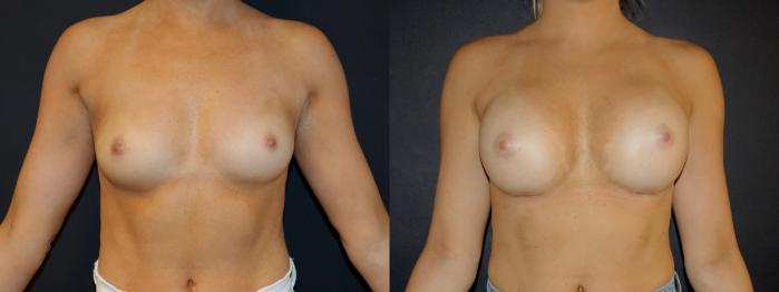 Before & After Breast Augmentation Case 105 Front View in Charleston, SC