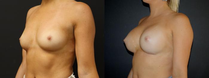 Before & After Breast Augmentation Case 105 Left Oblique View in Charleston, SC