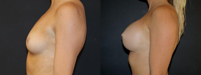 Before & After Breast Augmentation Case 105 Left Side View in Charleston, SC